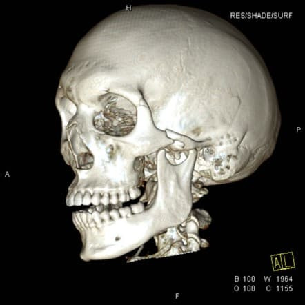 КТ костей лицевого черепа - снимки